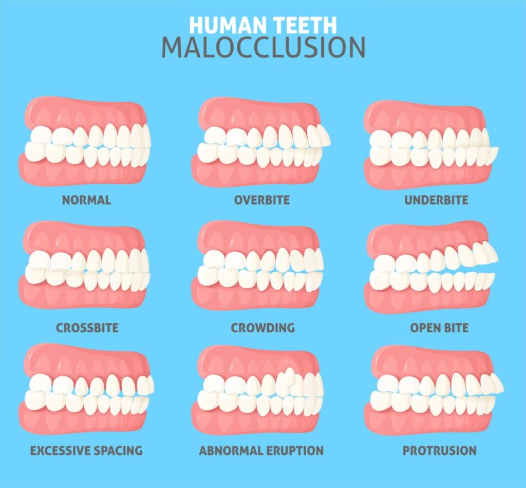 Le diverse tipologie di malocclusioni 